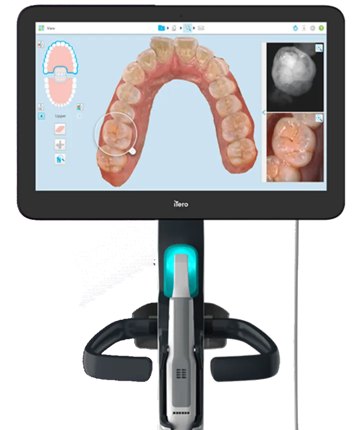 「アイテロエレメント5D」によるマウスピース矯正(インビザライン)